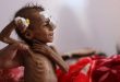UN warns of 'catastrophic' child malnutrition due to price hikes, Ukraine war