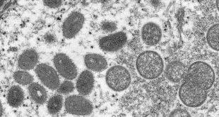 Third possible case of monkeypox found in the US