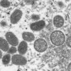 HCMC reports first monkeypox case